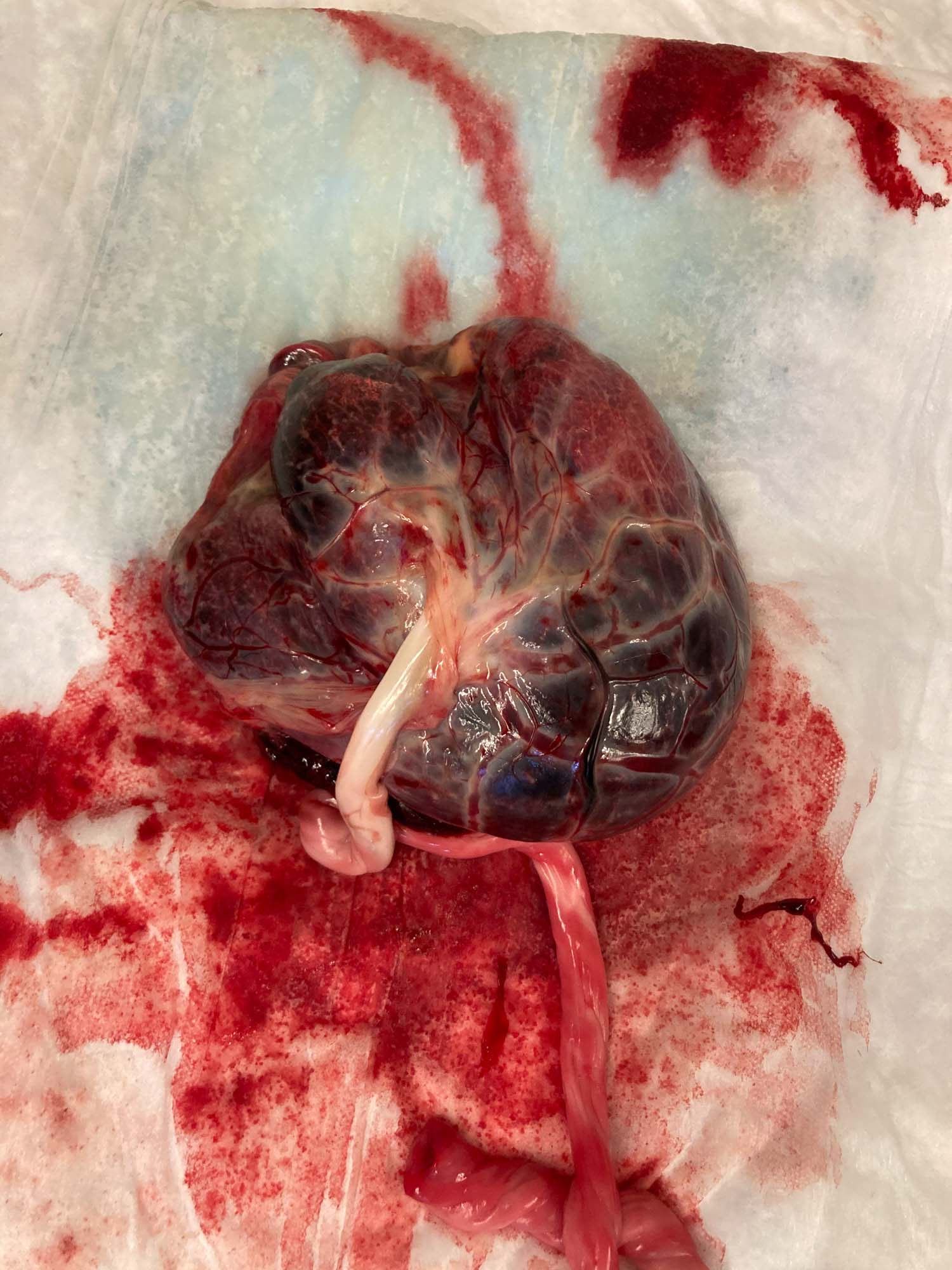 Placenta Birth Placenta Birth