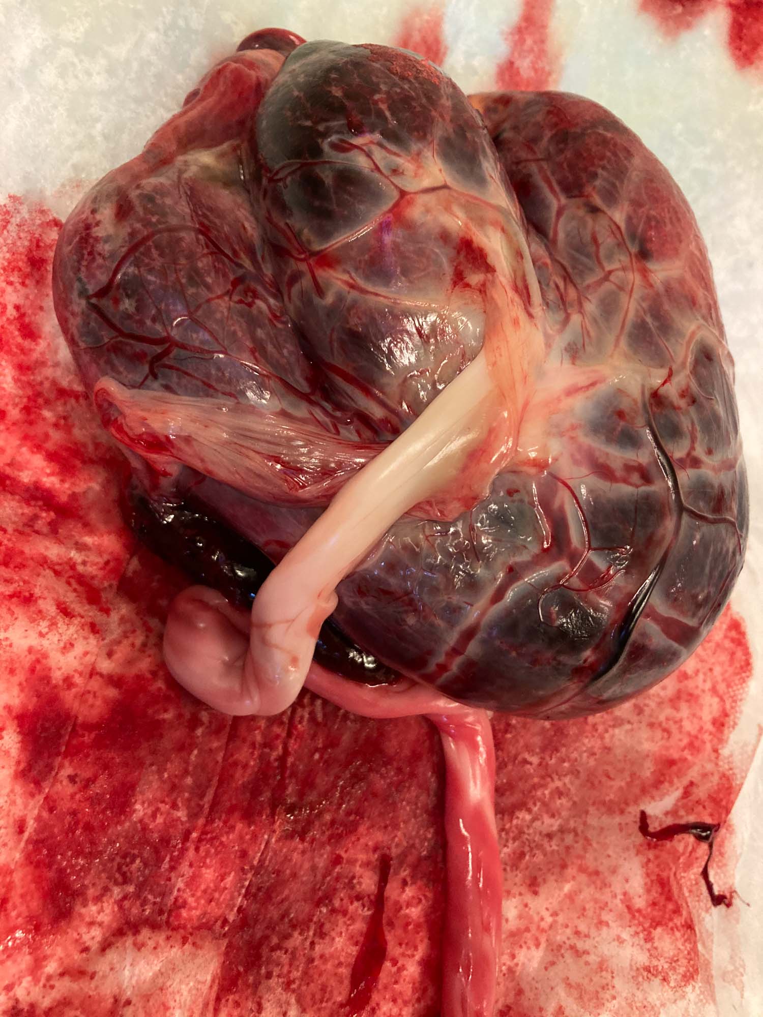 Retained Placenta