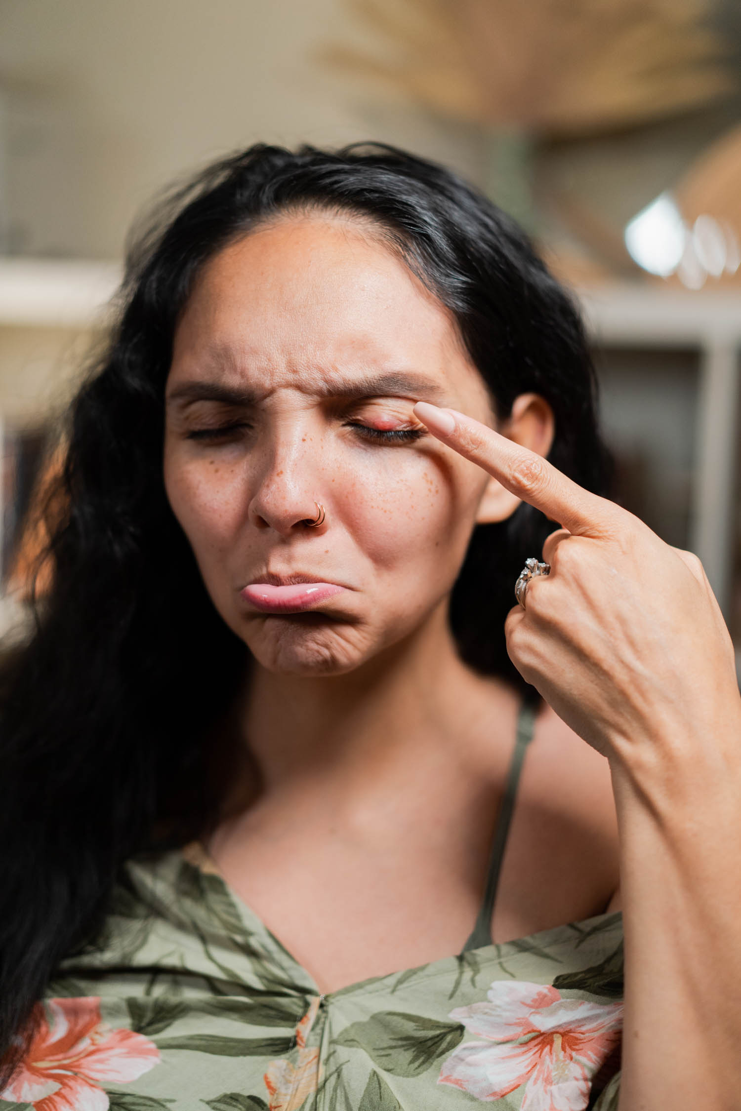 Chalazion Removal